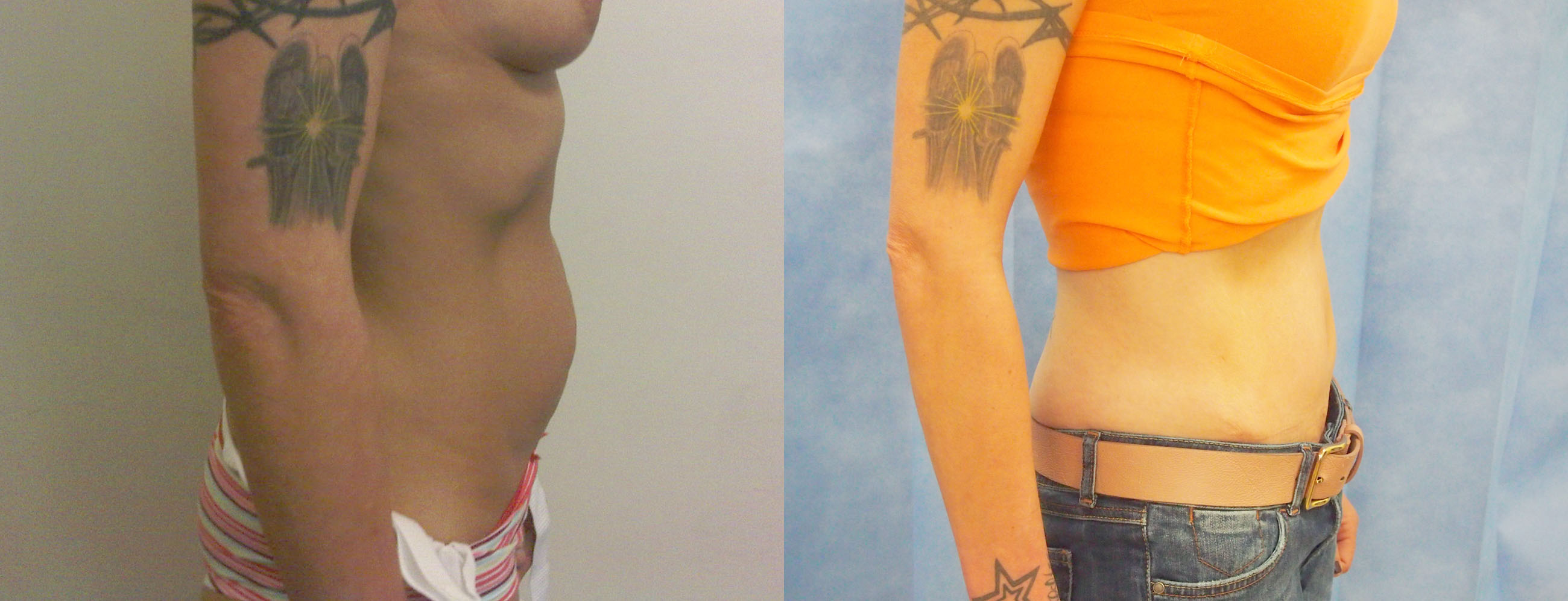 Abdominoplasty (Tummy Tuck) Before and Afters