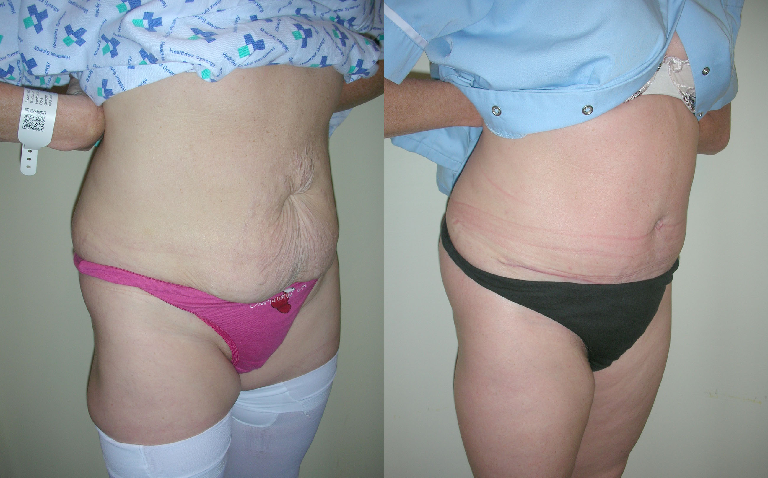 Abdominoplasty, Tummy Tuck, Manchester and London