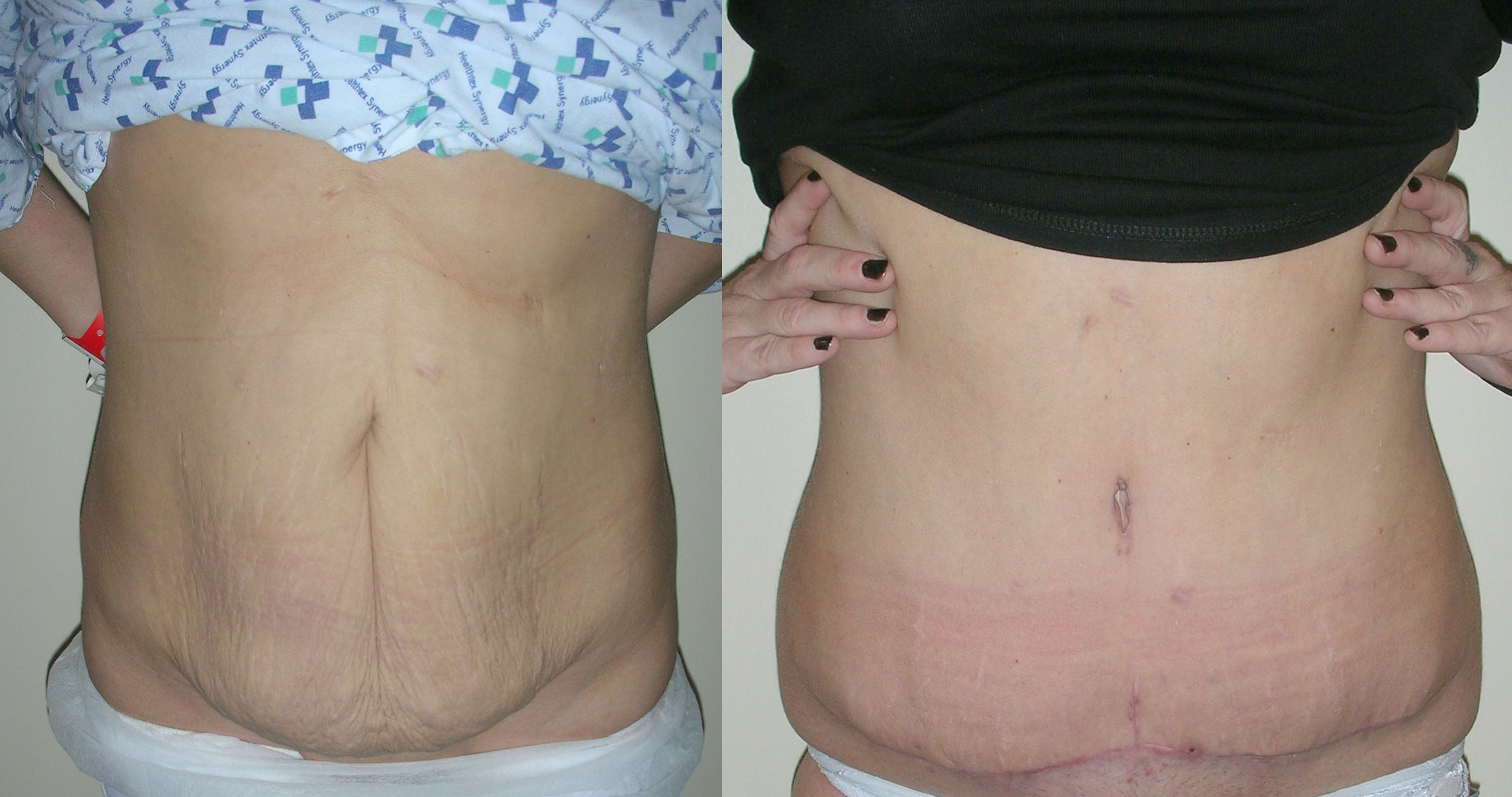Abdominoplasty (Tummy Tuck) Before and Afters