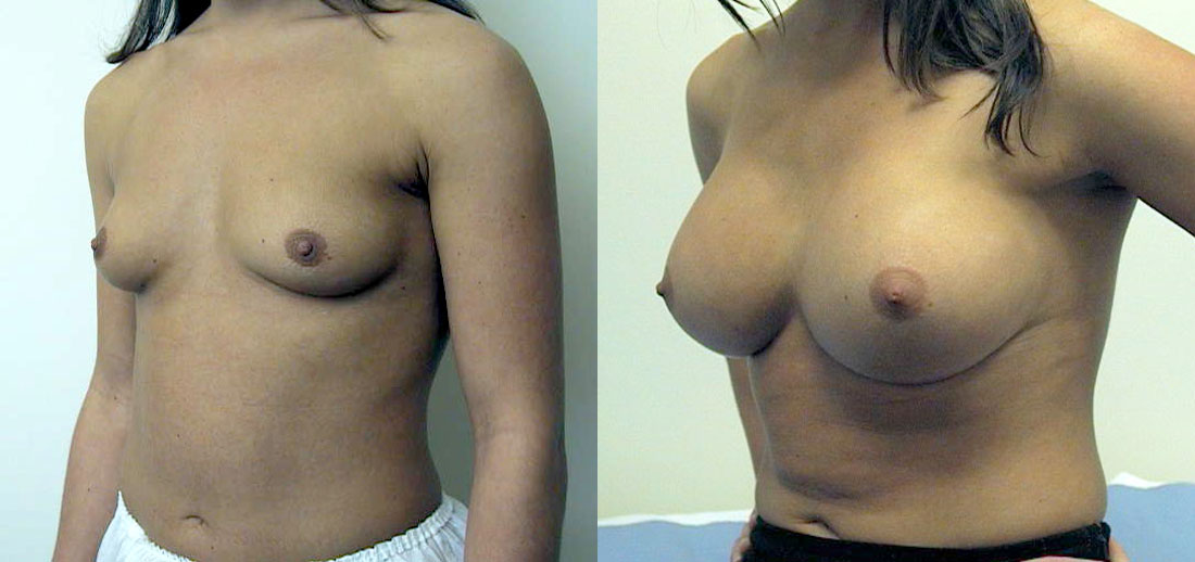 Breast enlargement, augmentation, implants, boob job, Manchester and London