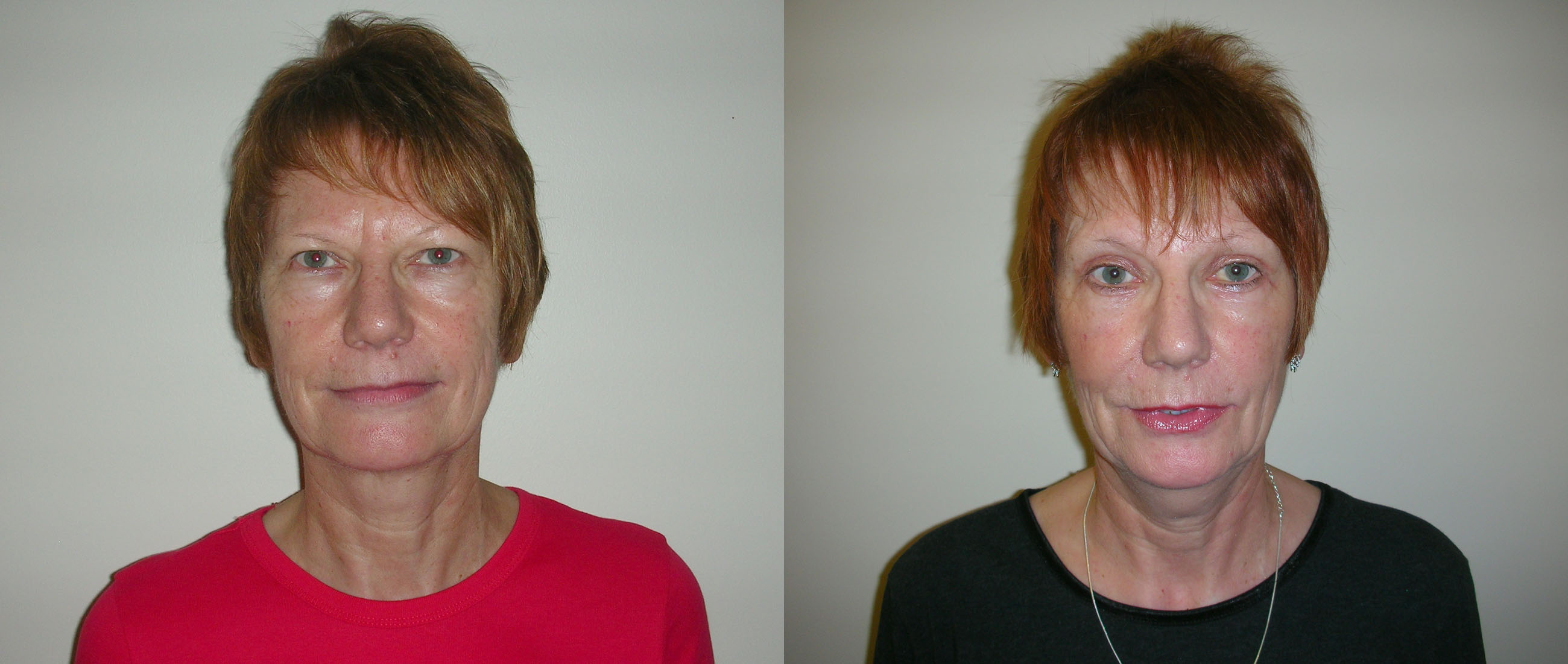 Eyelid Surgery Before and Afters