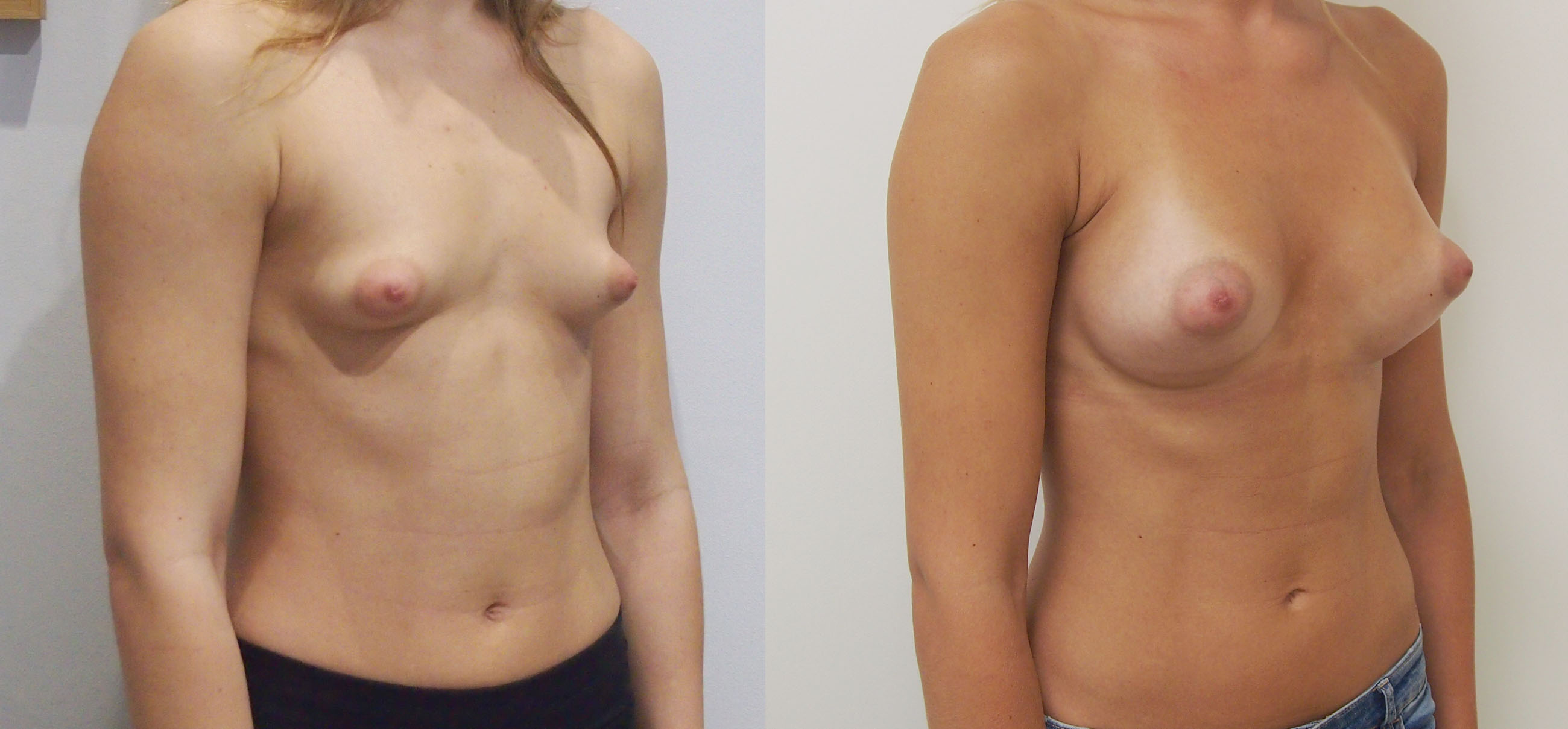 Breast Enlargement Before and Afters