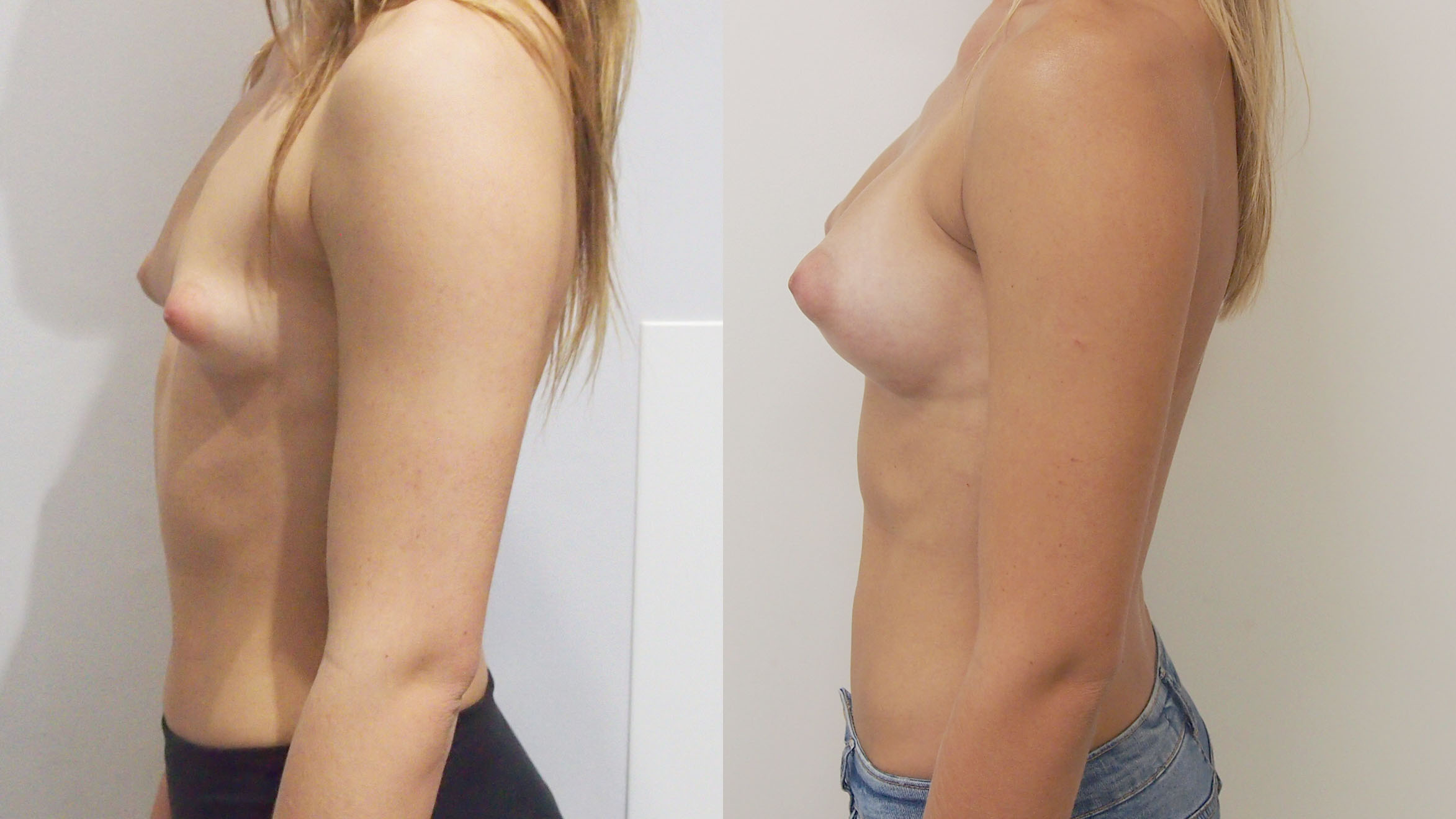 Breast Enlargement Before and Afters