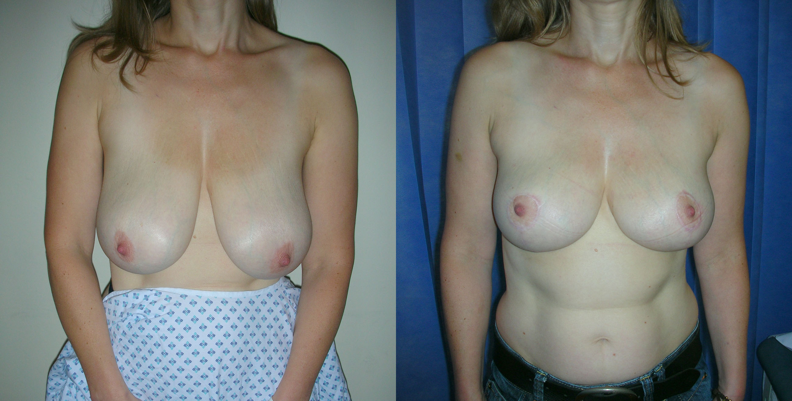 Breast Reduction Before and Afters