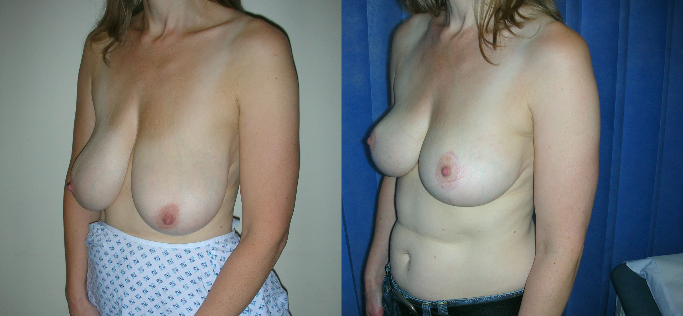 Breast Reduction Manchester and London