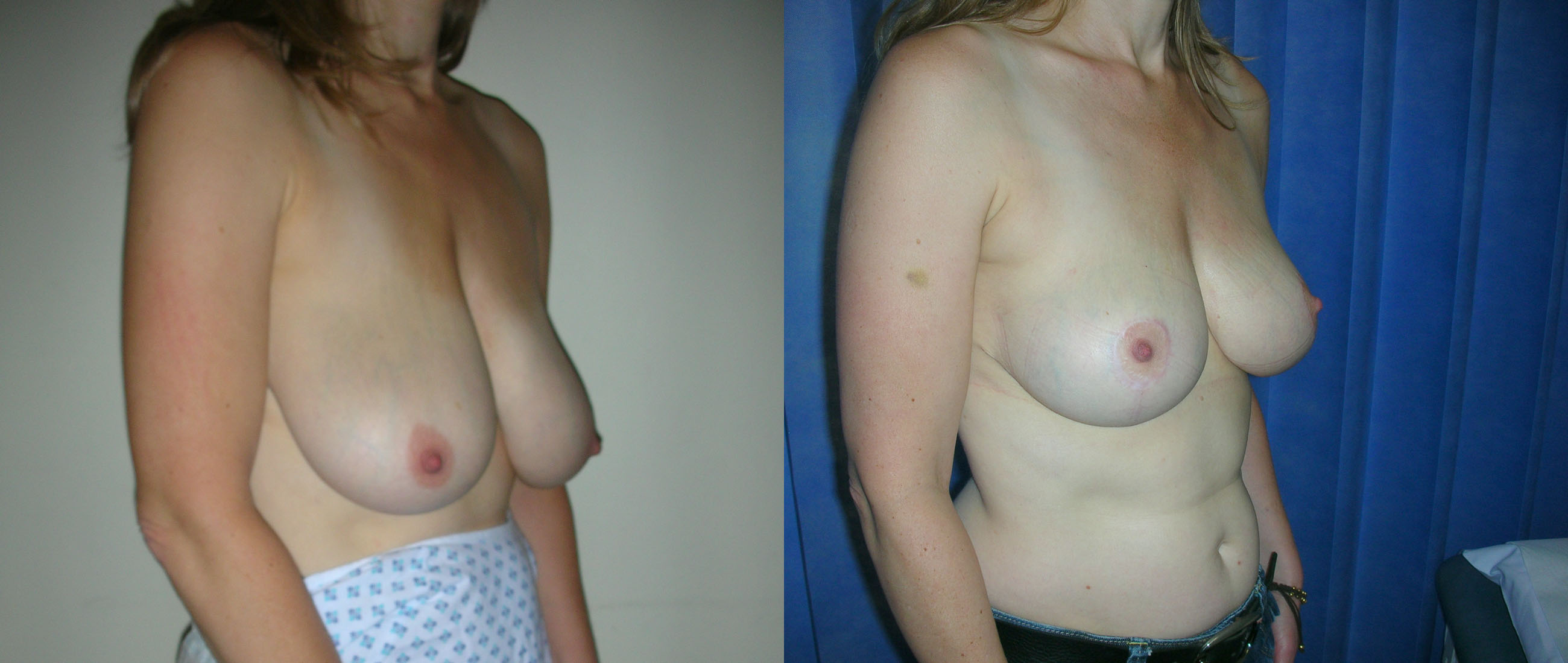 Breast Reduction Before and Afters