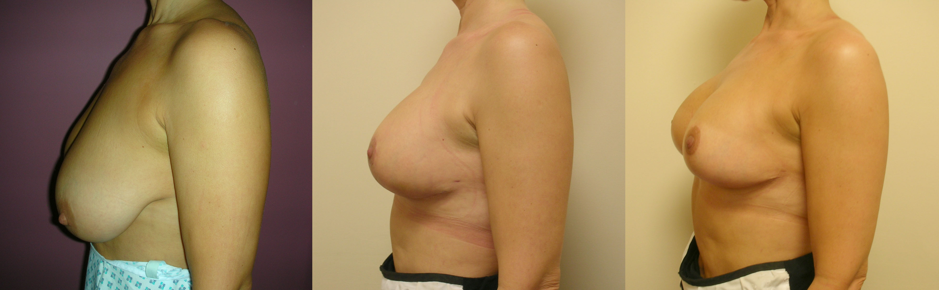 Breast-uplift-implants-boob-job-manchester3