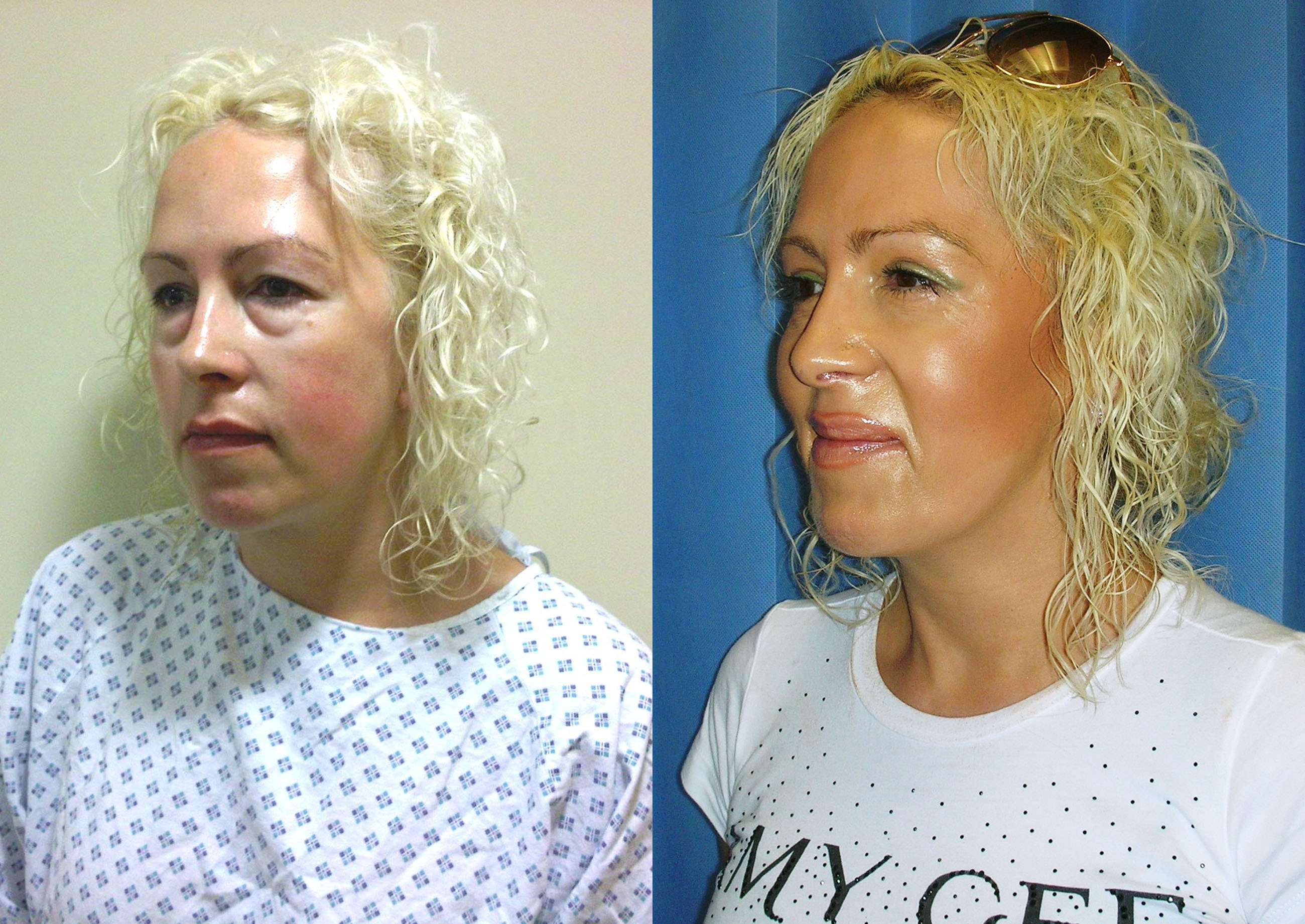 Eyelid Surgery Before and Afters