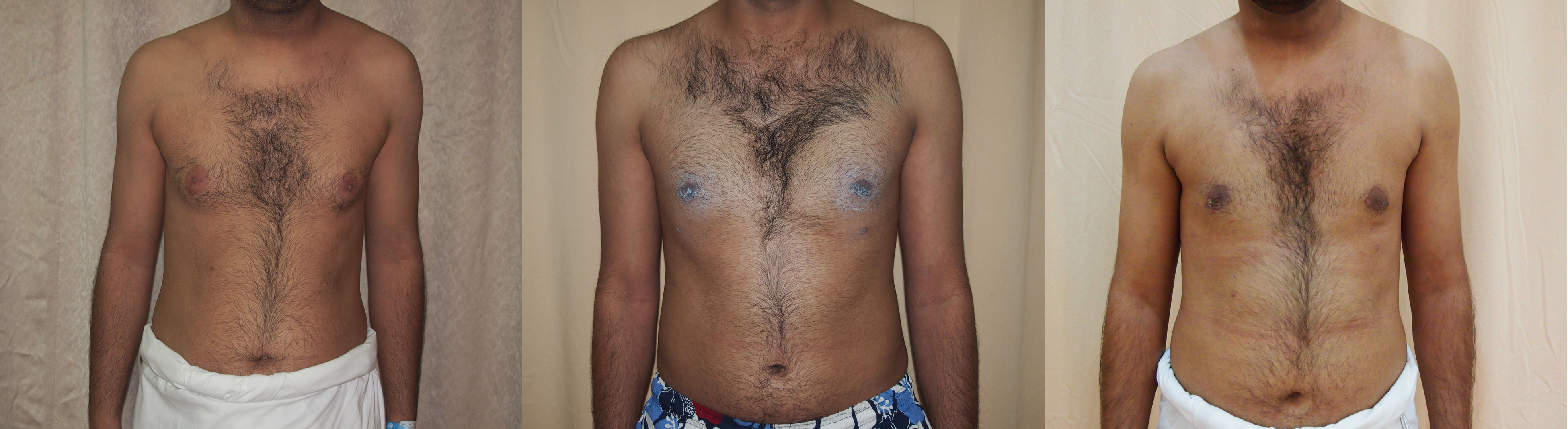 Male chest reduction surgery in London and Manchester