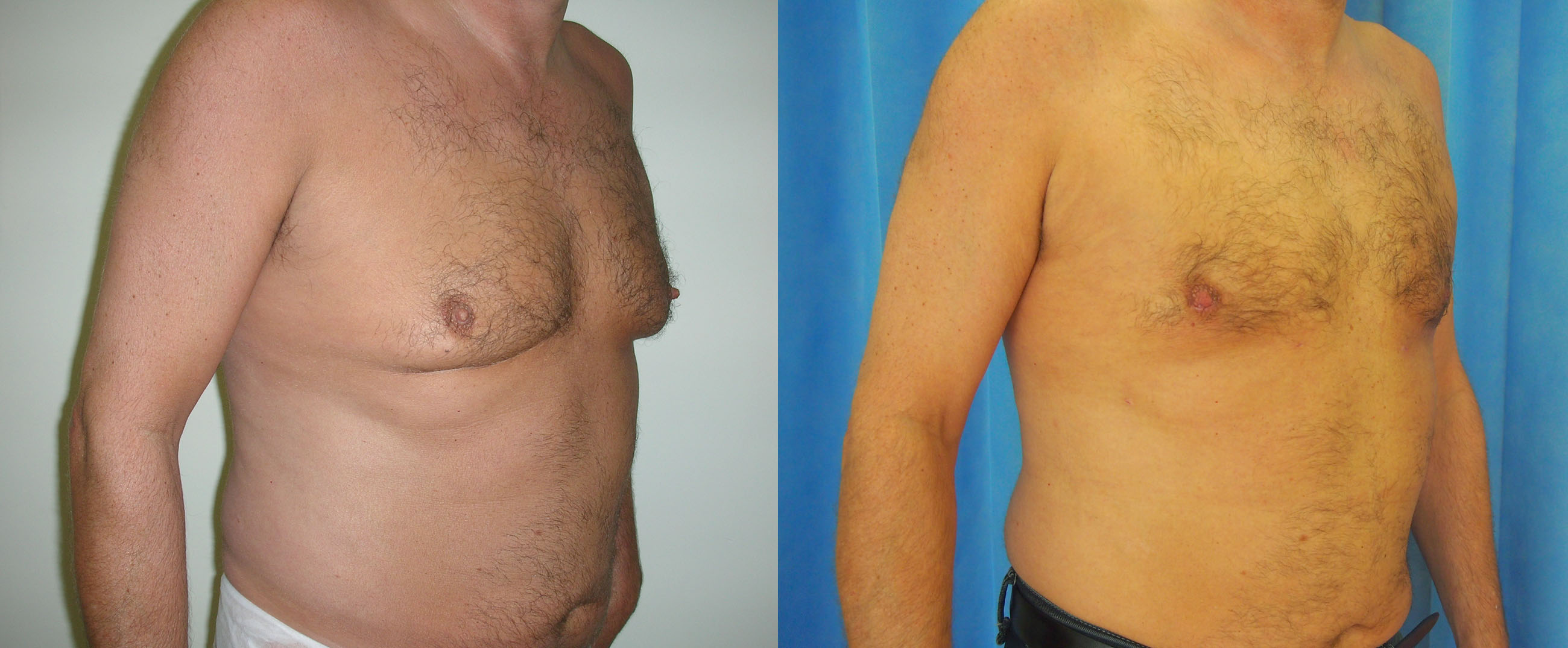Male chest reduction surgery in London and Manchester