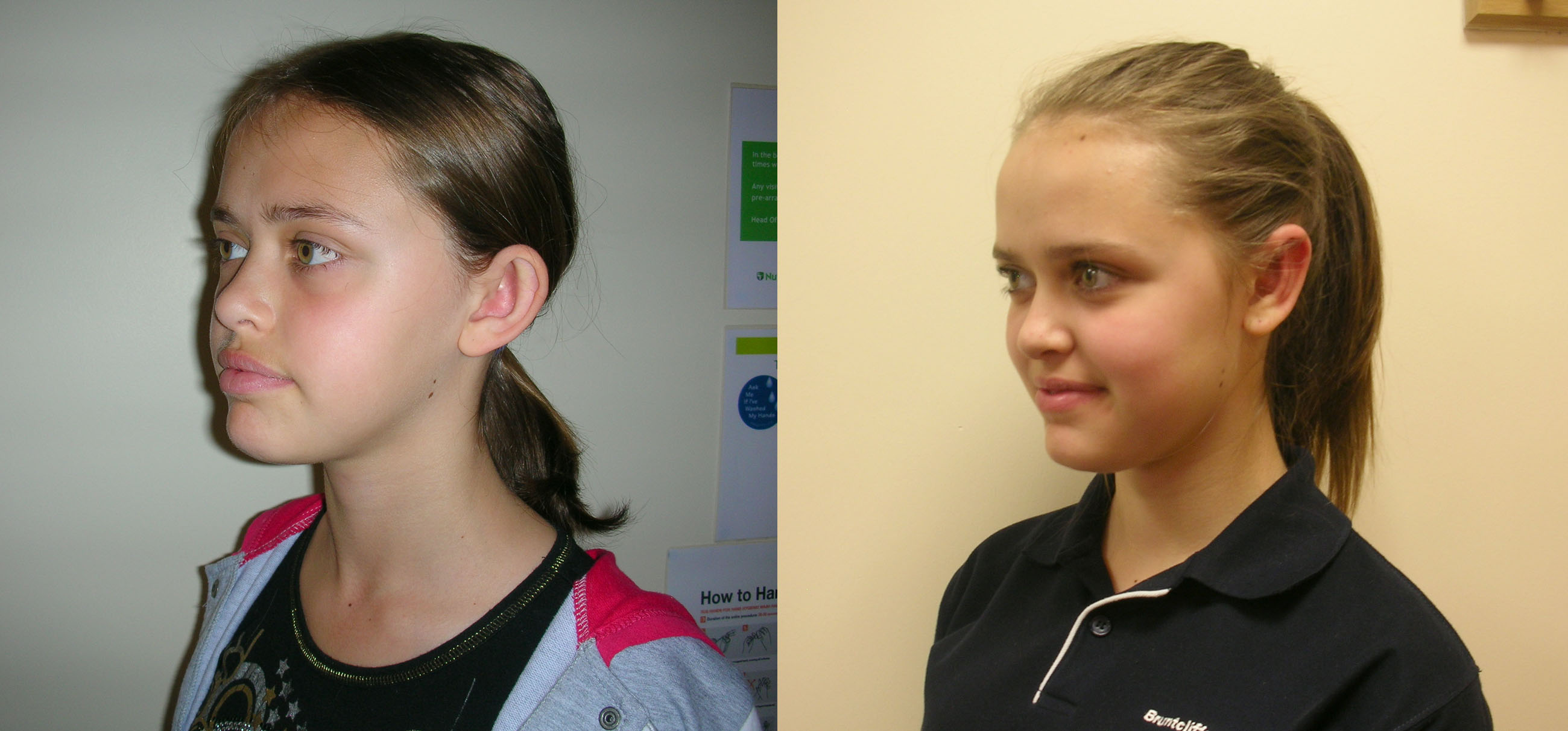 Prominent ears/pinnaplasty surgery in Manchester and London