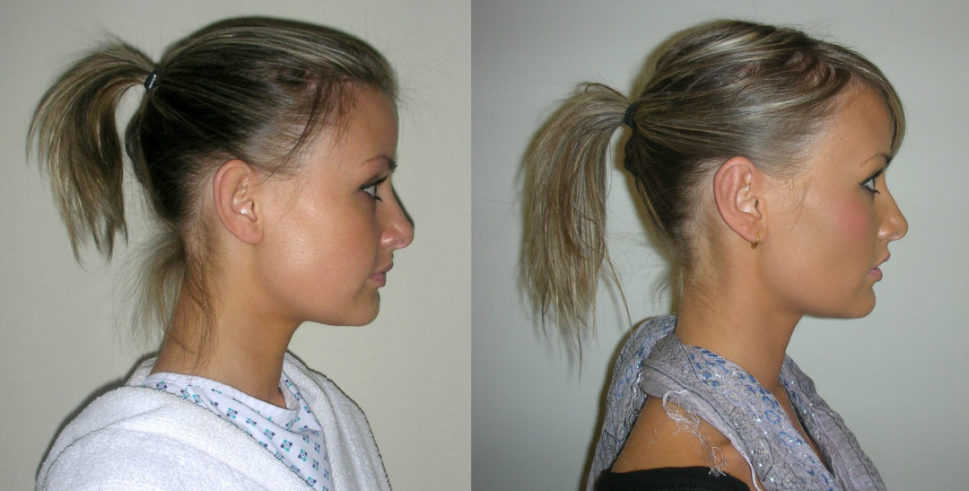 Prominent ears/pinnaplasty surgery in Manchester and London Waseem