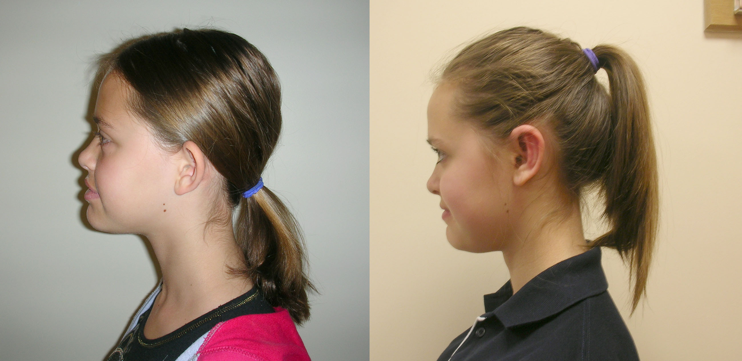Prominent ears/pinnaplasty surgery in Manchester and London