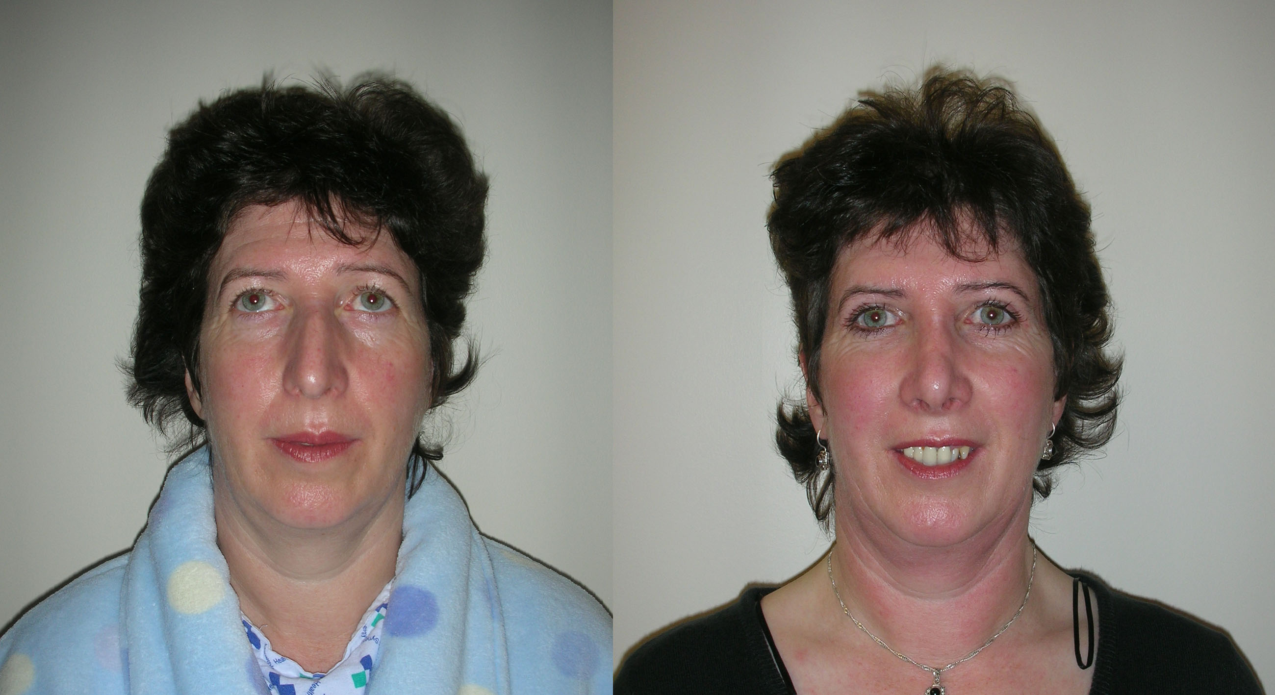 Rhinoplasty / Nose Job surgery in Manchester and London