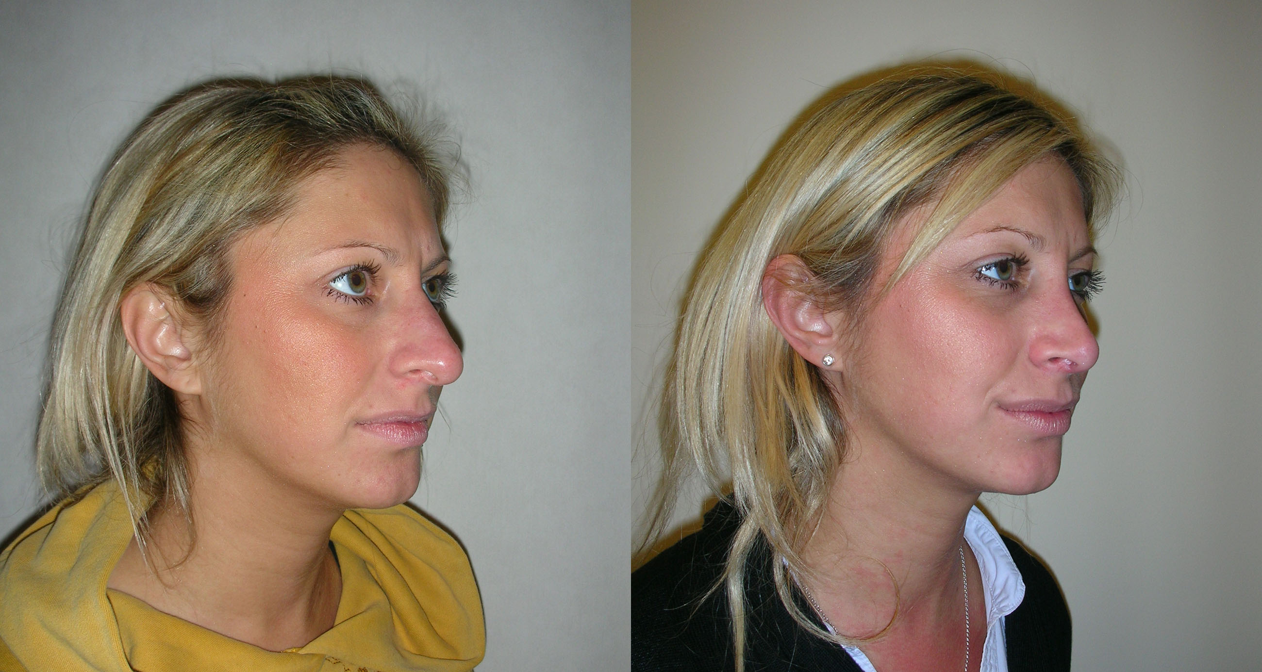 Rhinoplasty / Nose Job surgery in Manchester and London - Waseem Saeed - Plastic Surgeon