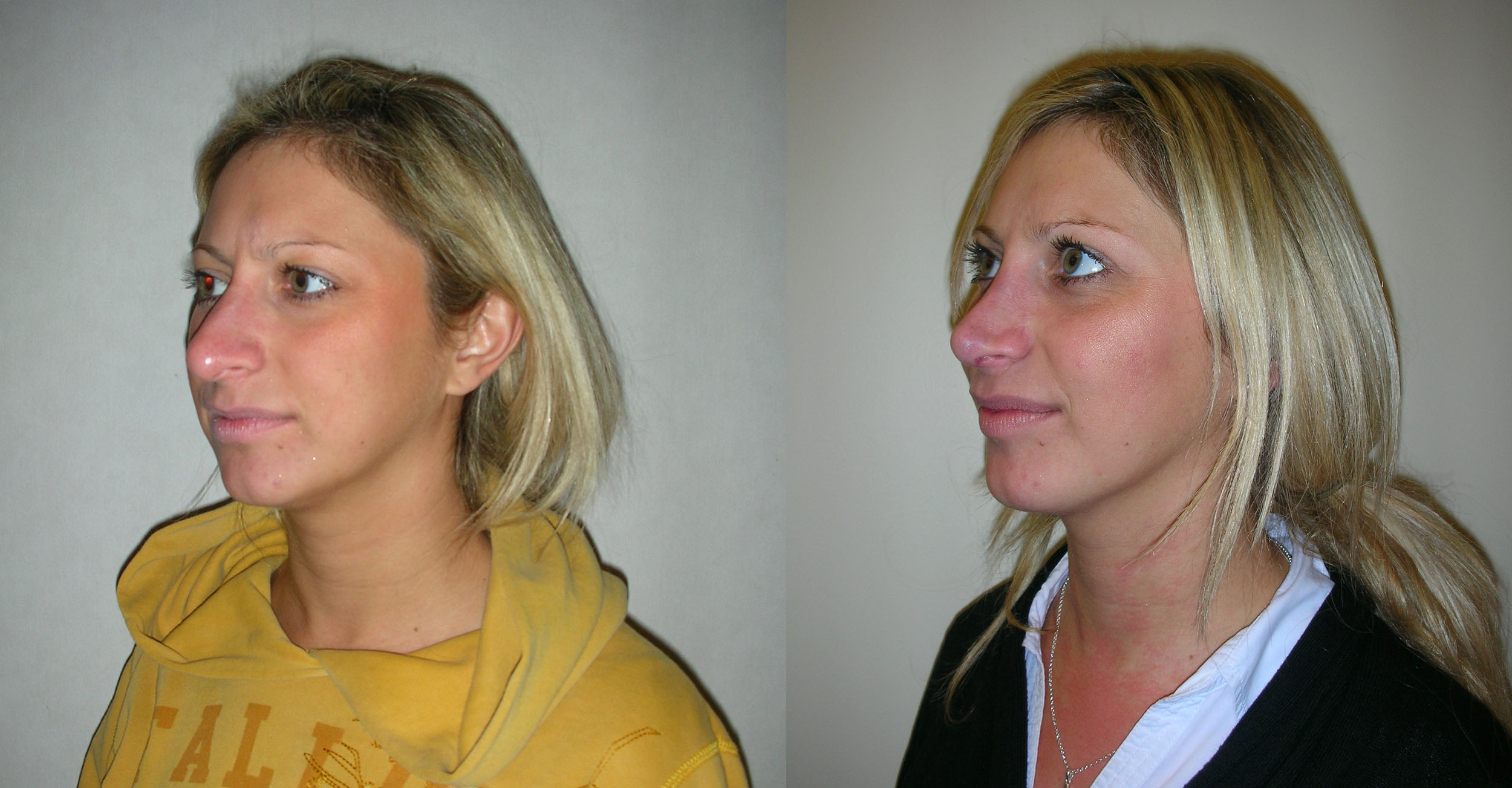 Rhinoplasty / Nose Job surgery in Manchester and London
