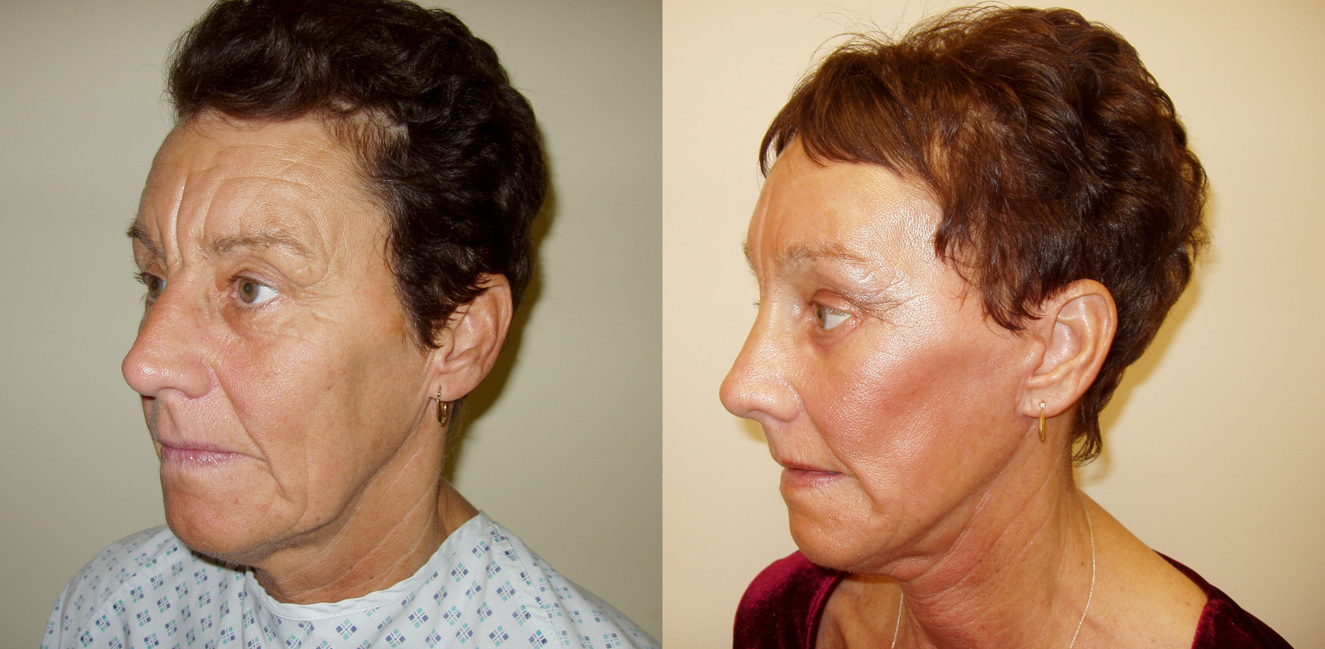 face lift / brow lift / eyelid lift surgery in Manchester and London