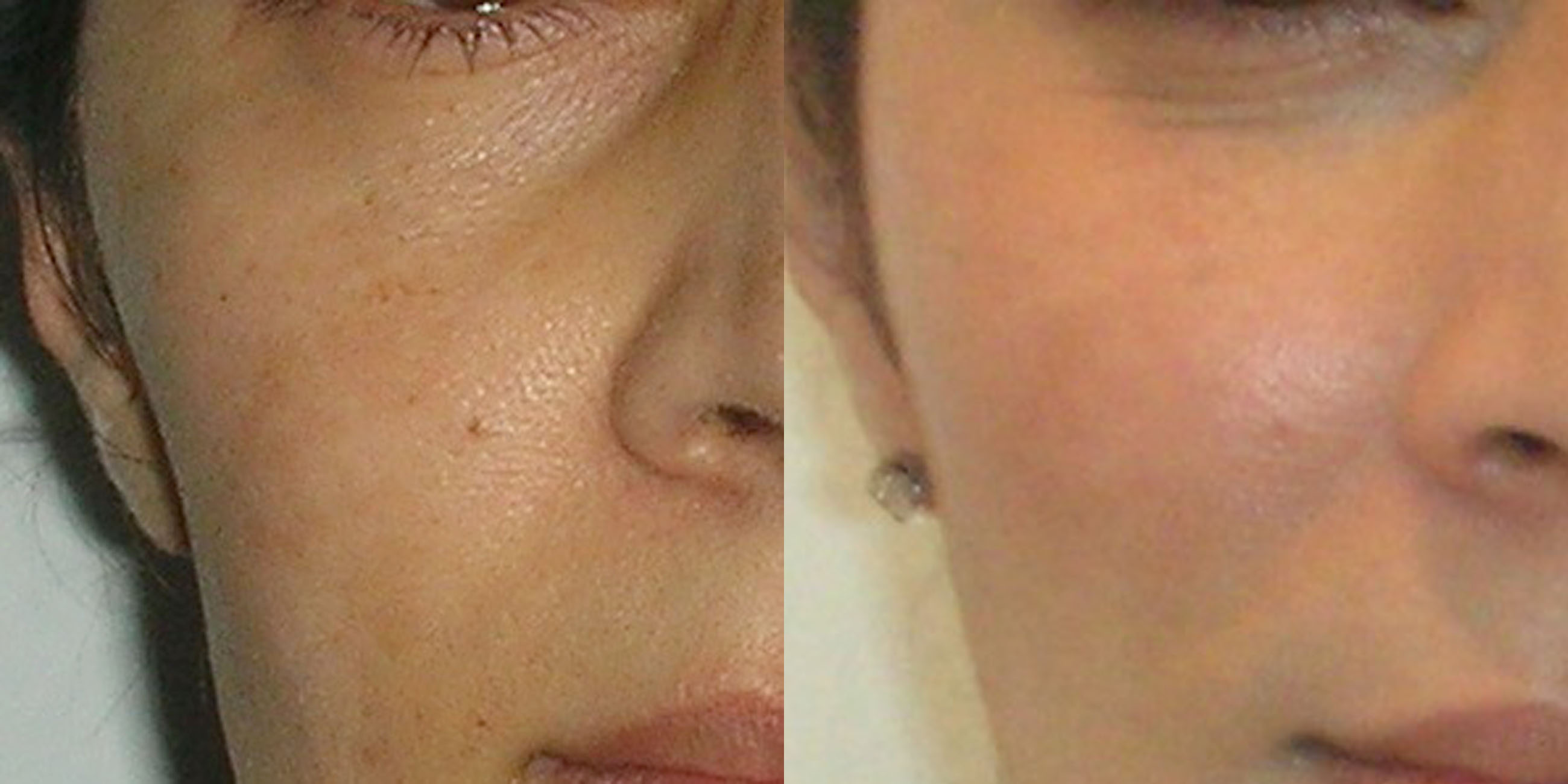 Fat transfer / lipofilling of the face in Manchester and London