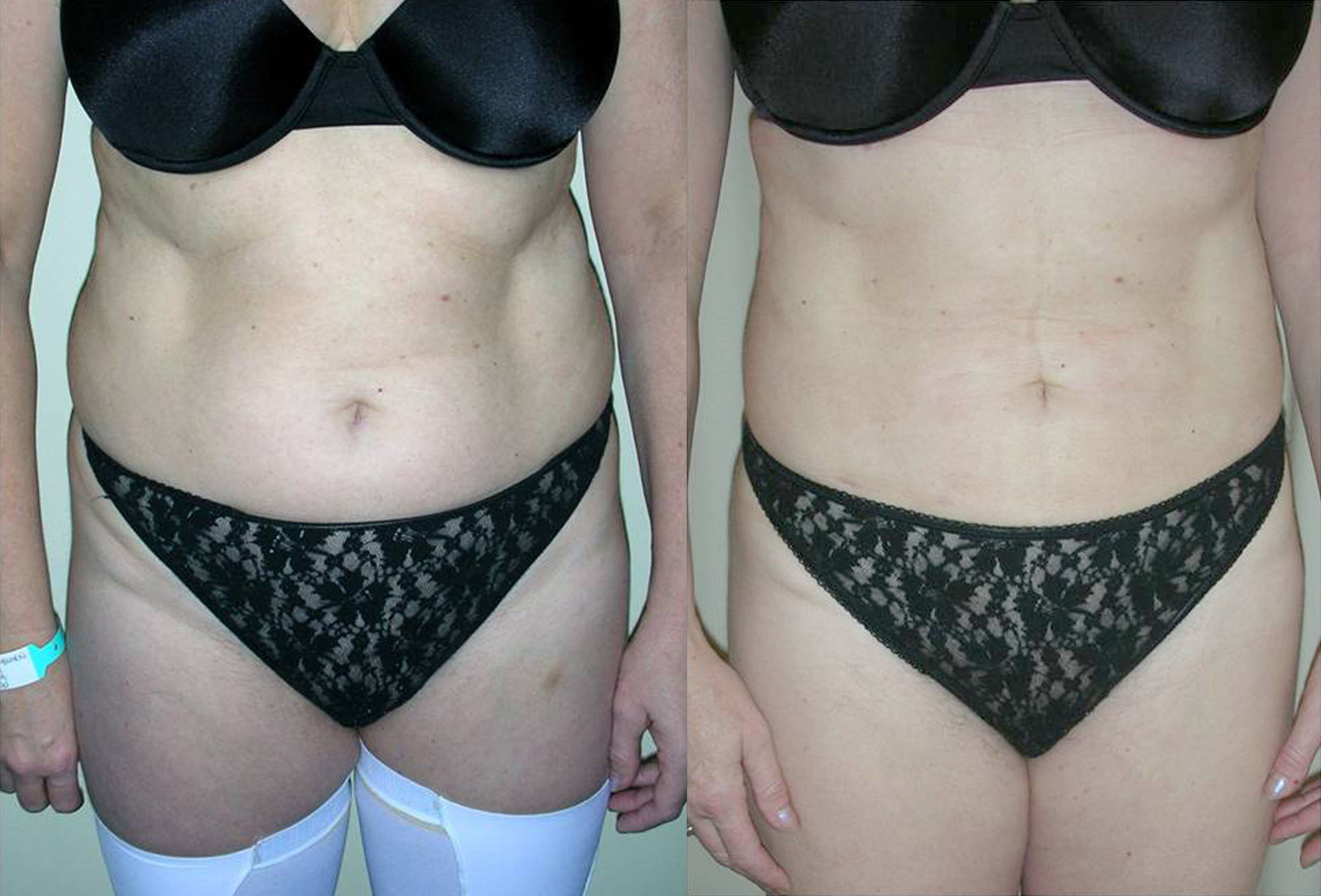Liposuction surgery in Manchester and London