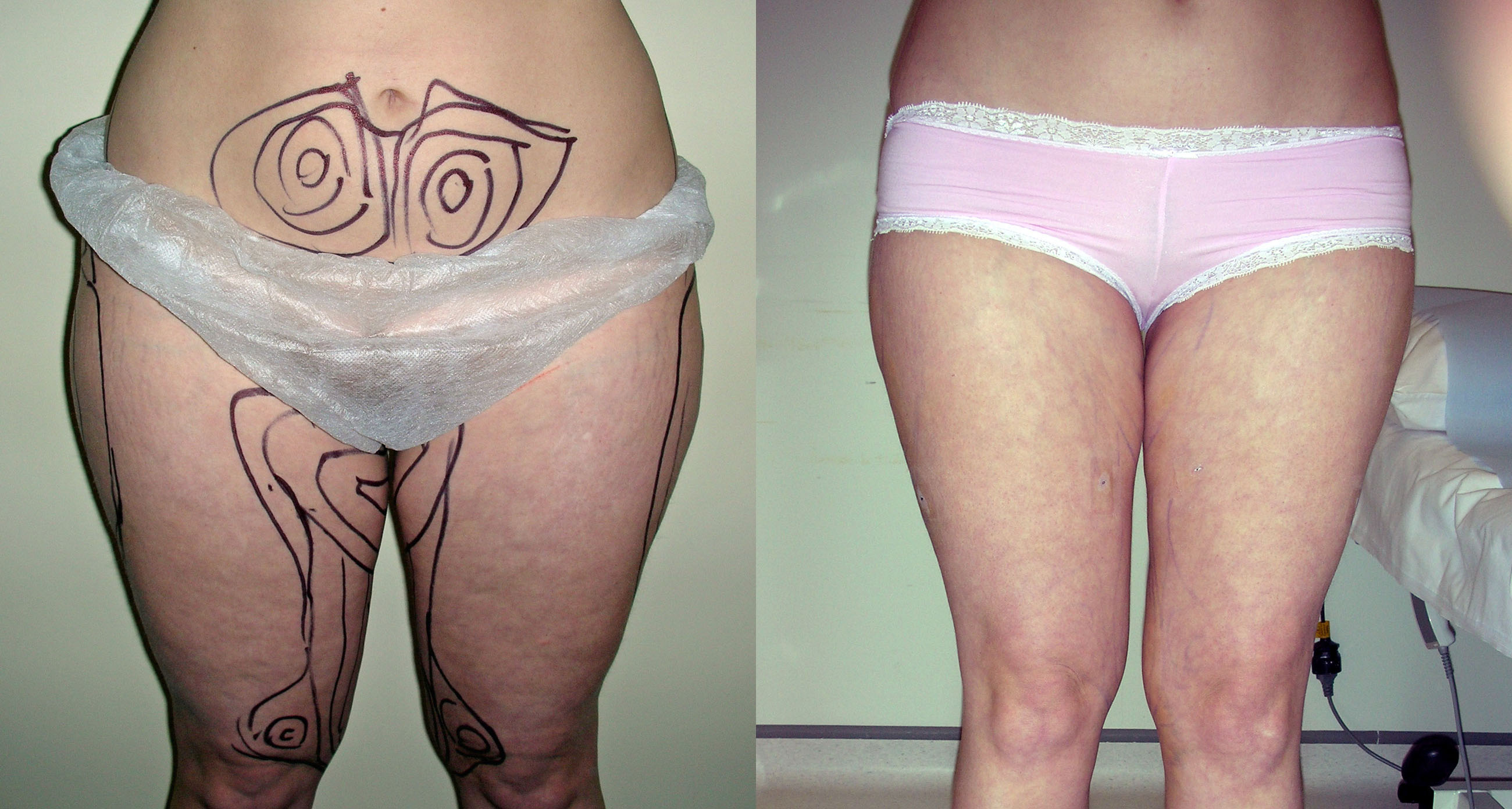 liposuction-thighs-abdomen-manchester-london
