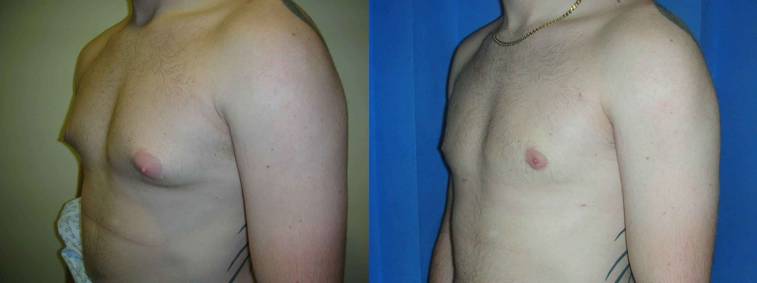 Male chest reduction surgery in Manchester and London